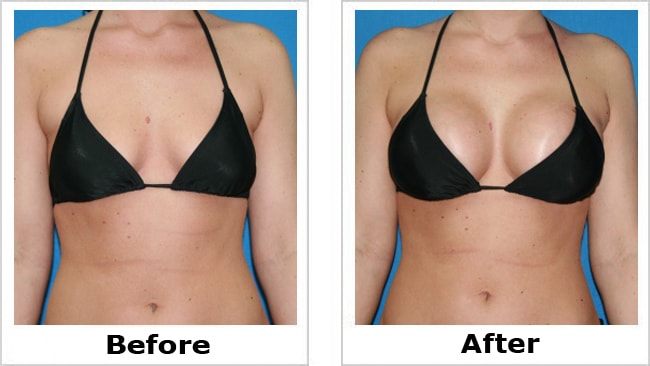 Combined Breast UpLift & Breast Enlargement Surgery (Augmentation